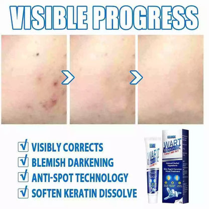 WartAway Herbal Removal Cream